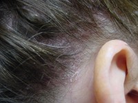 псориаз на голове