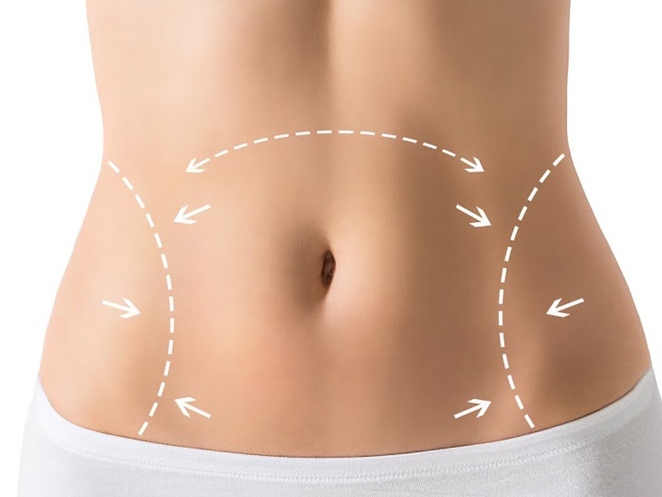 Подтяжка живота