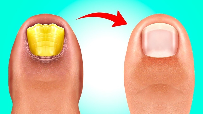 Как вылечить грибок ногтей