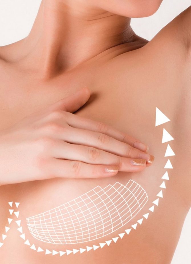 Как происходит подтяжка груди