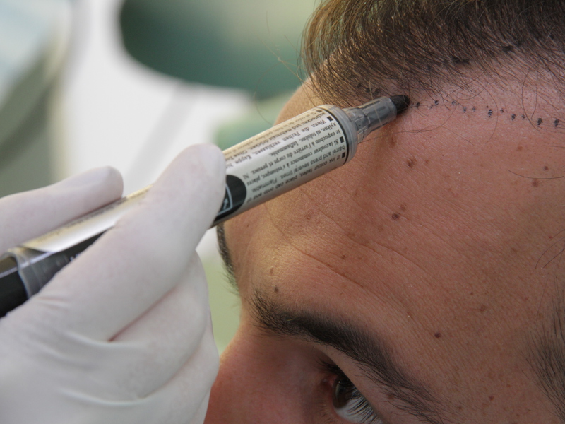 Пересадка волос: кому и когда можно воспользоваться услугой