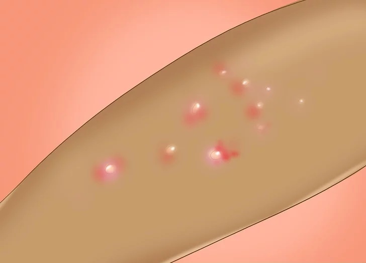 Контагиозный моллюск на лице