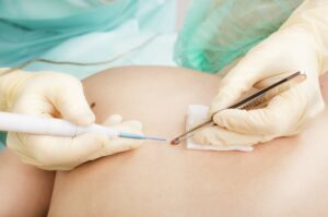 Какая подготовка необходима при удалении родинок