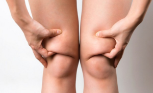 Безоперационная липосакция ног: безопасное и эффективное решение