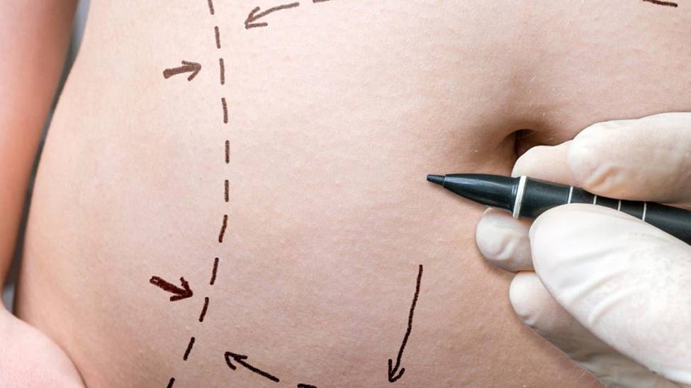 Бариатрическая хирургия: преобразующее решение для снижения веса