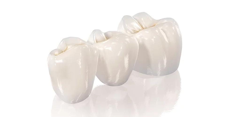 Виды зубных коронок