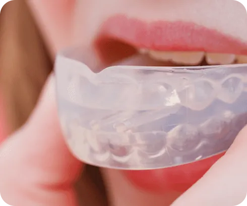 Ночные капы от бруксизма: защита зубов во сне