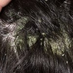 Проявления себорейного дерматита на волосистой части головы: фото, действенные методы лечения и особенности ухода за волосами при заболевании методы лечения себорейного дерматита на волосистой части головы