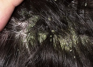 Проявления себорейного дерматита на волосистой части головы: фото, действенные методы лечения и особенности ухода за волосами при заболевании методы лечения себорейного дерматита на волосистой части головы