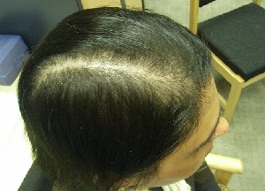 Заболевание под названием алопеция — что это такое? Причины возникновения, распространённые виды недуга и способы его лечения методы лечения алопеции