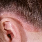 Эффективные методы и правила лечения псориаза на голове: фото заболевания и особенности ухода за волосами методы лечения псориаза на голове