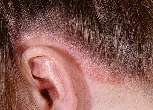 Эффективные методы и правила лечения псориаза на голове: фото заболевания и особенности ухода за волосами методы лечения псориаза на голове