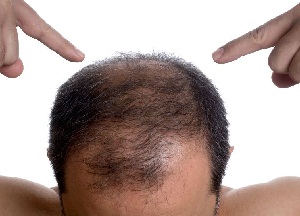 Поредение шевелюры или облысение у мужчин: причины и лечение народными средствами и лекарственными препаратами методы лечения облысения у мужчин