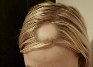 Гнёздная или очаговая алопеция у женщин: лечение лекарственными препаратами, народными средствами и физиотерапевтическими процедурами как лечить очаговую алопецию у женщин