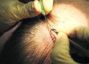 Эффективная процедура против выпадения локонов — пересадка волос: цена, суть и особенности методики, этапы проведения как делают пересадку волос
