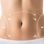 Подтяжка живота