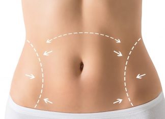 Подтяжка живота