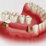 Где узнать стоимость установки коронки или мост на 4 зуба