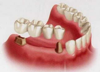 Где узнать стоимость установки коронки или мост на 4 зуба