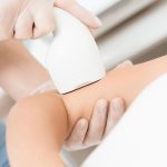 Как проходит лазерная эпиляция рук