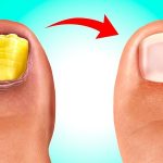 Как вылечить грибок ногтей