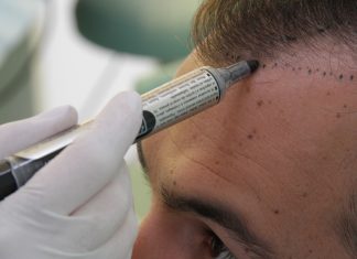 Пересадка волос: кому и когда можно воспользоваться услугой