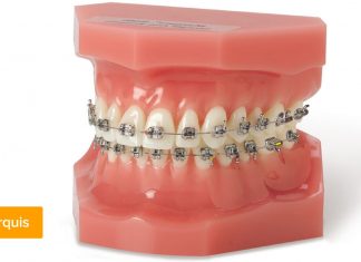 Для чего нужны брекеты