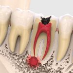 Киста на корне зуба — как ее лечить?