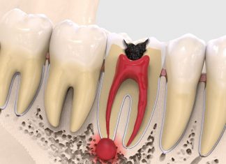 Киста на корне зуба — как ее лечить?