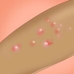 Контагиозный моллюск на лице