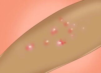 Контагиозный моллюск на лице