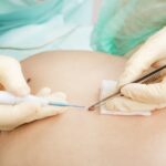 Какая подготовка необходима при удалении родинок