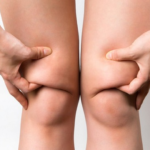 Безоперационная липосакция ног: безопасное и эффективное решение