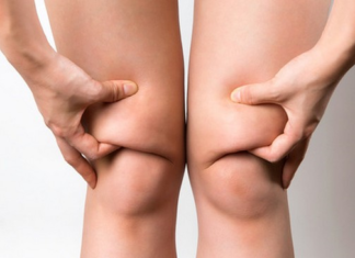 Безоперационная липосакция ног: безопасное и эффективное решение