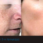 Омоложение BBL Forever Young: будьте уверенными себе в любом возрасте