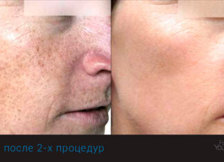 Омоложение BBL Forever Young: будьте уверенными себе в любом возрасте