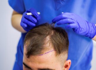 Трансплантация волос: решение проблемы выпадения волос