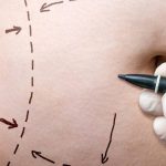 Бариатрическая хирургия: преобразующее решение для снижения веса