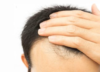 Повысьте свою уверенность с помощью операции по пересадке волос