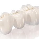 Виды зубных коронок