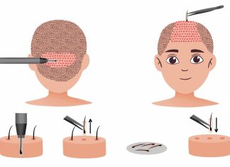 Как происходит пересадка волос