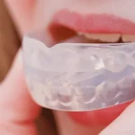 Ночные капы от бруксизма: защита зубов во сне