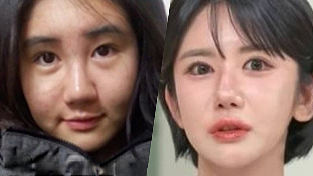 Женщина за 15 лет сделала 400 пластических операций