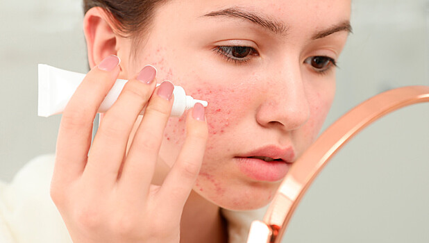 Почему после моря появляются прыщи и что с этим делать