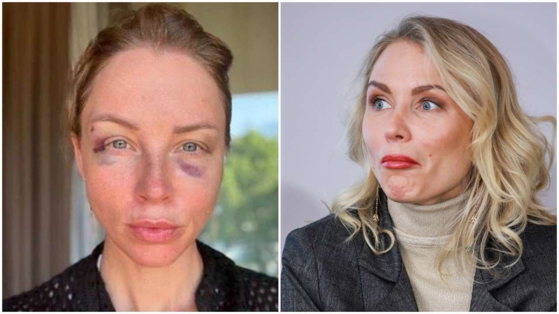 «Можно ли так упасть?»: Гордон намекнула на происхождение синяков на лице Дибровой